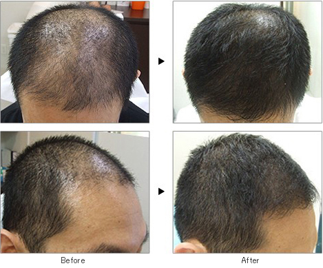 Как использовать миноксидил. Minoxidil 10 percent. Миноксидил для волос на голове. Миноксидил для волос для мужчин для головы. Миноксидил до и после для головы.